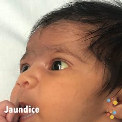 Hesi newborn jaundice case study studies