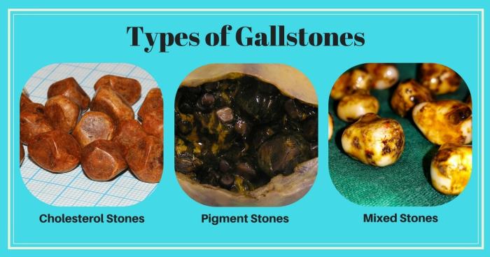 Gallbladder ultrasound cholelithiasis gallstones gall radiology cholecystitis stone stones stepwards contains abdominal distended radiopaedia tests show choose board ehealthstar